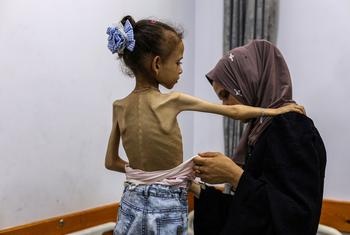 A severely malnourished girl in Gaza. Aid teams have repeatedly called for Israel to allow much more aid to enter Gaza to prevent the ongoing humanitarian catastrophe, Image courtesy the WHO.